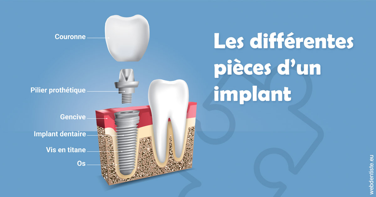 https://www.docteur-renault-hager.fr/Les différentes pièces d’un implant 1